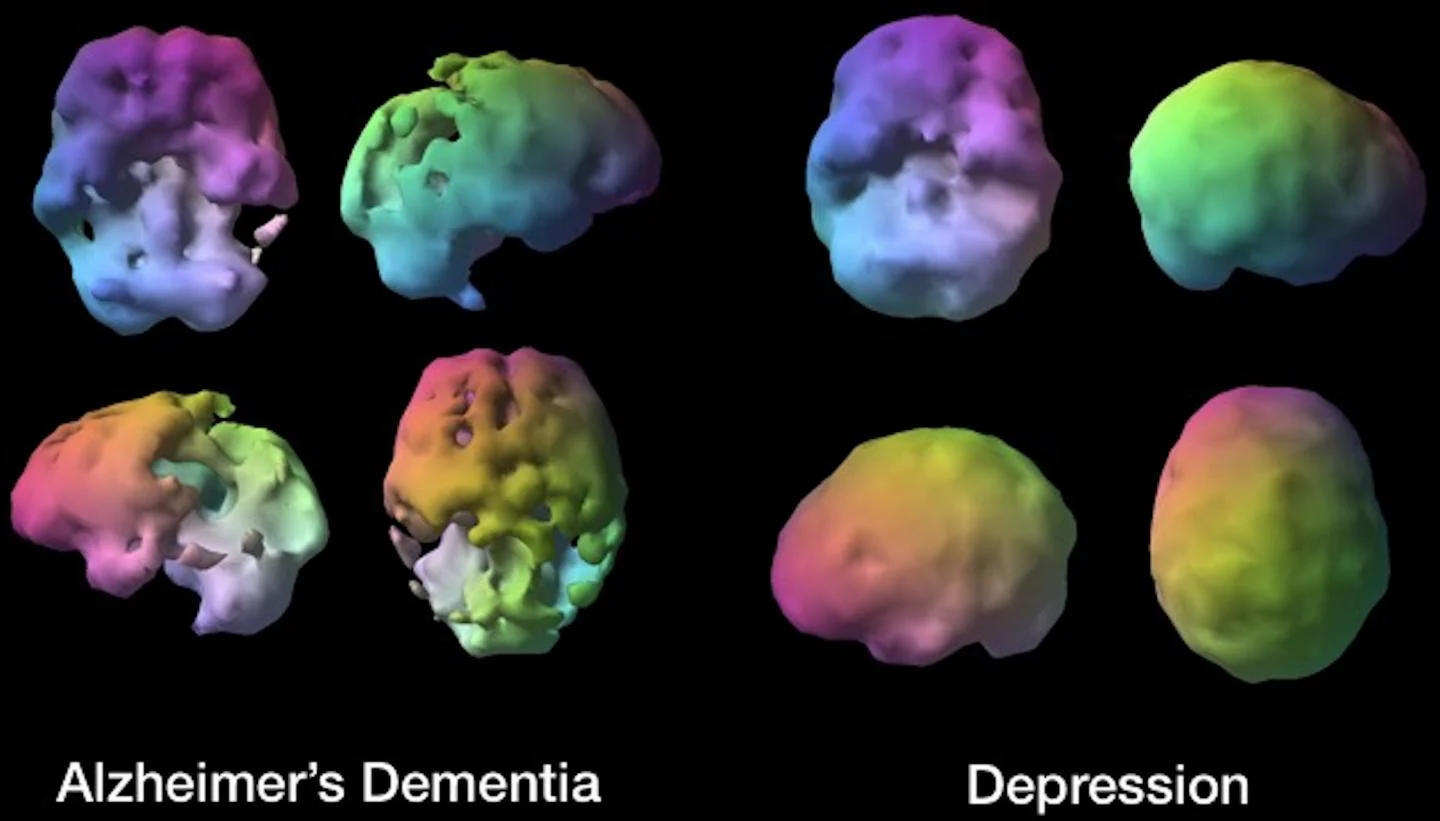 distinguishing alzheimer's disease from dementia